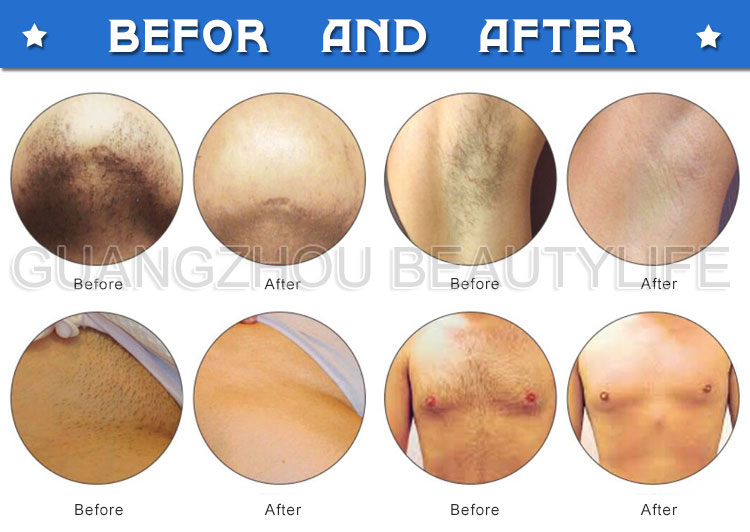 808nm diode laser treatment