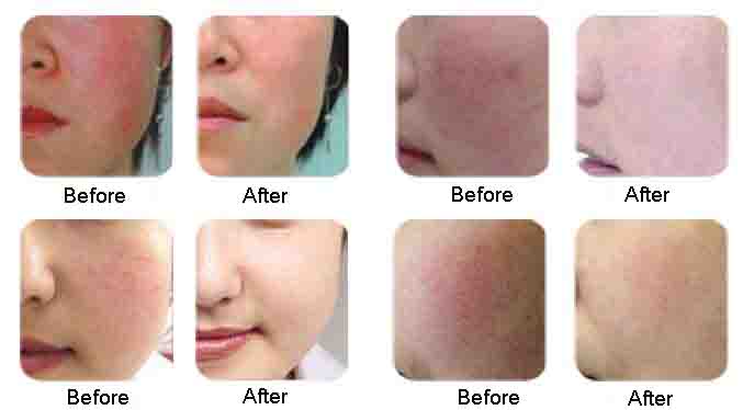 spider veins removal 