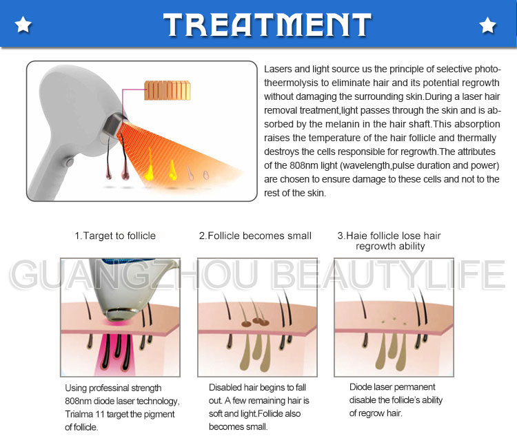 808nm diode hair removal laser