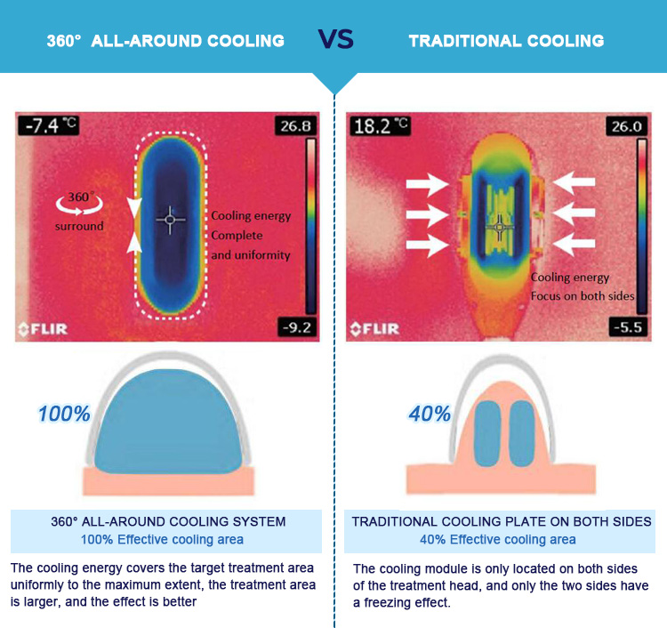 360 degree cryotherapy