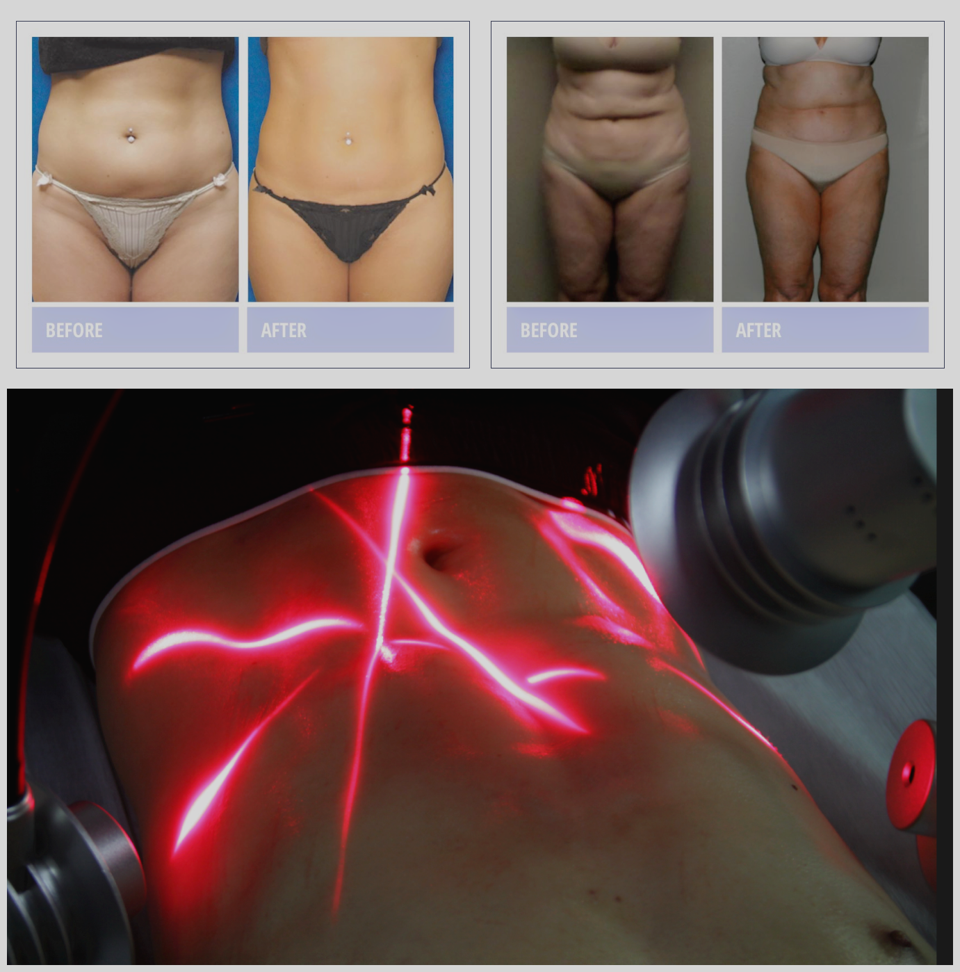 6d laser slimming machine 