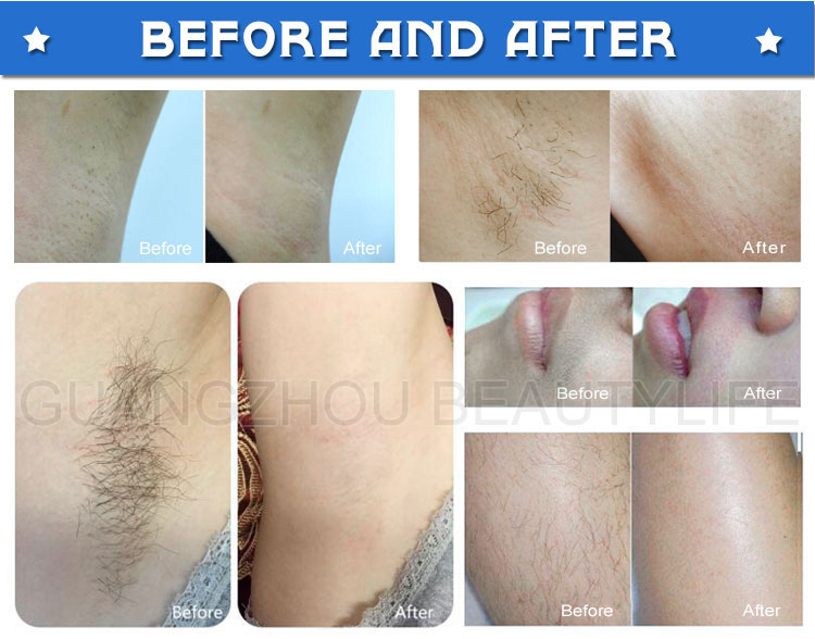 laser hair removal