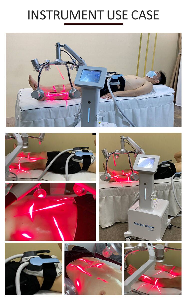 laser emsculpting