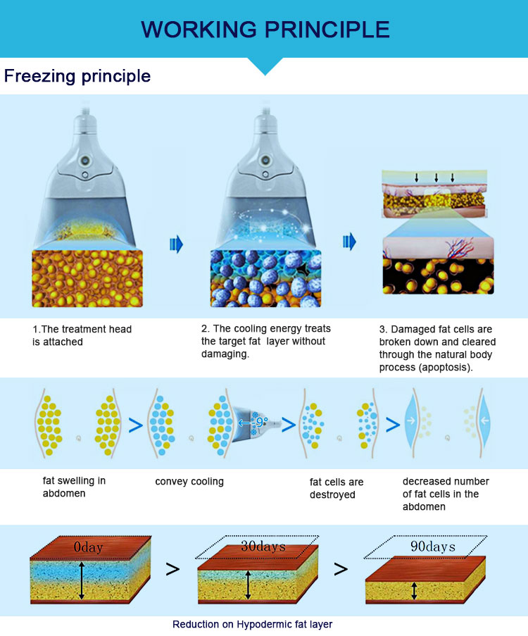 cryo fat freezing 
