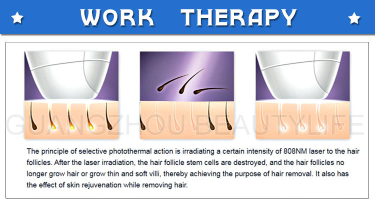laser hair removal treatment