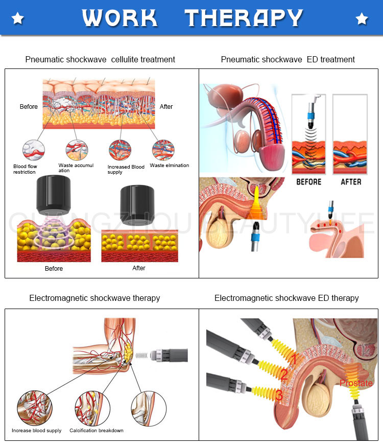 pneumatic shockwave therapy