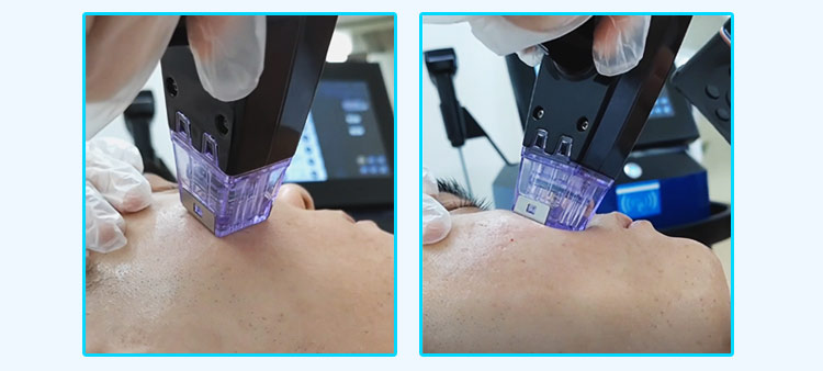 fractional microneedle rf 
