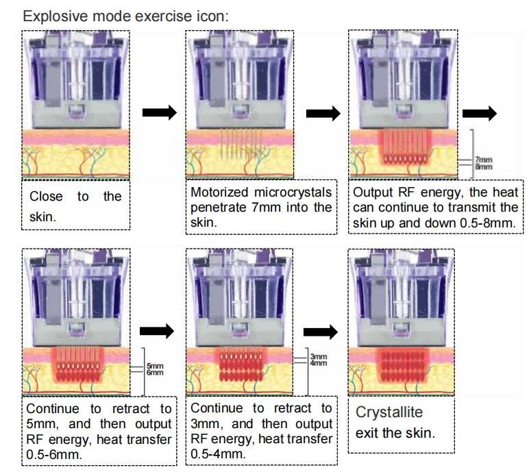 fractional rf microneedle