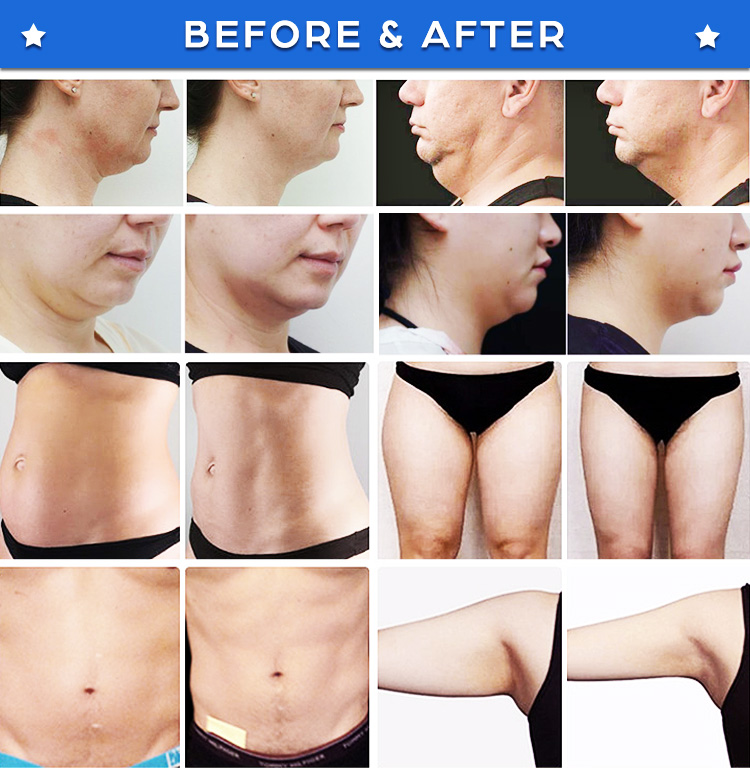 cryolipolysis double chin fat removal