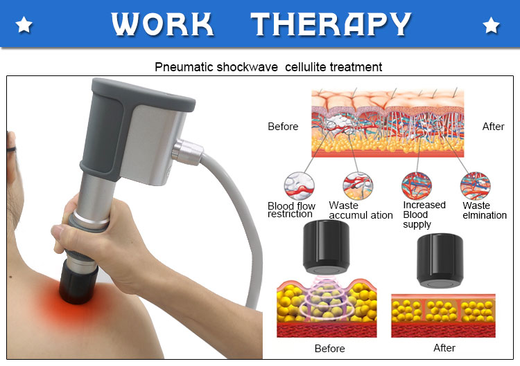 pneumatic shockwave therapy handle