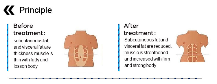 emsculpt muscle building