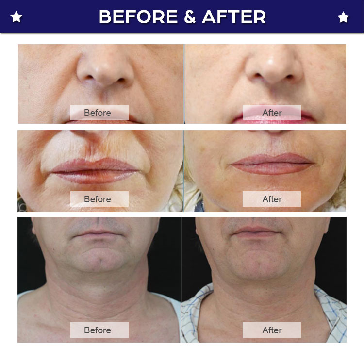 7d hifu machine treatment result