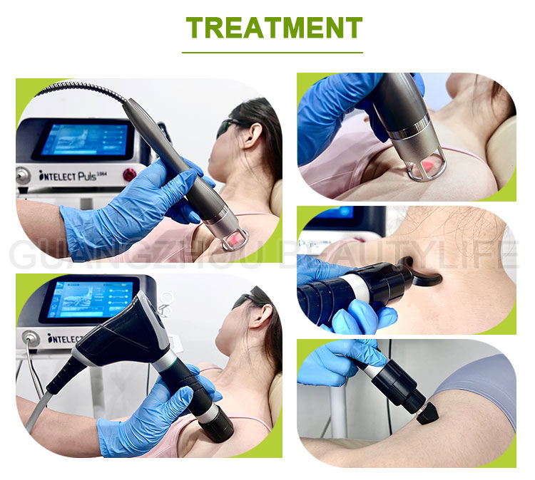 1064nm laser pain therapy