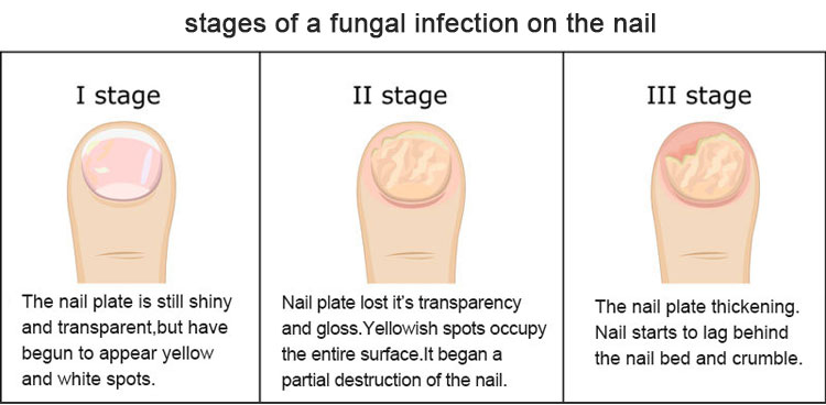 nail fungus laser treatment