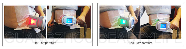 cryolipolysis treatment