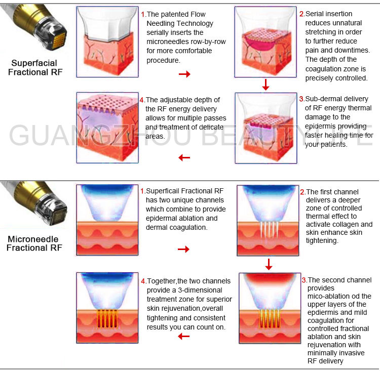 fractional rf microneedle