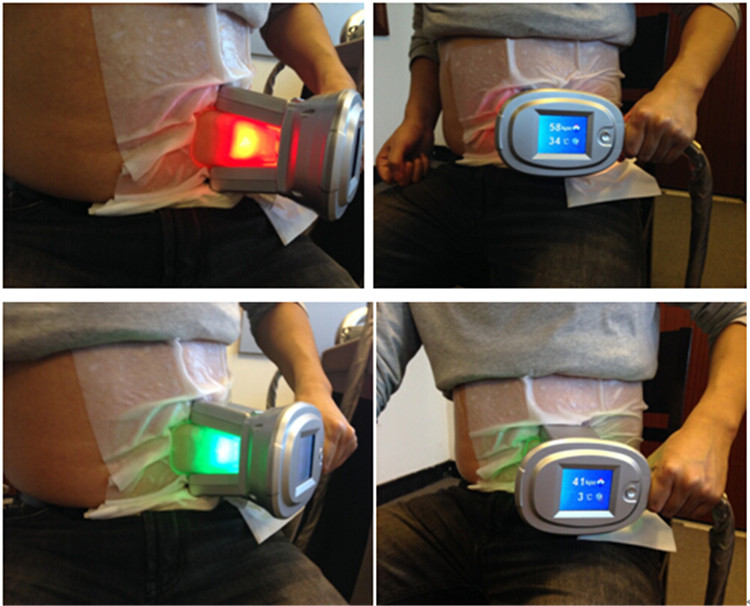 cryolipolysis treatment
