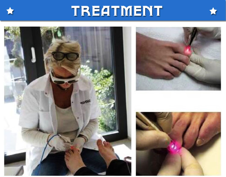 nail fungus laser therapy