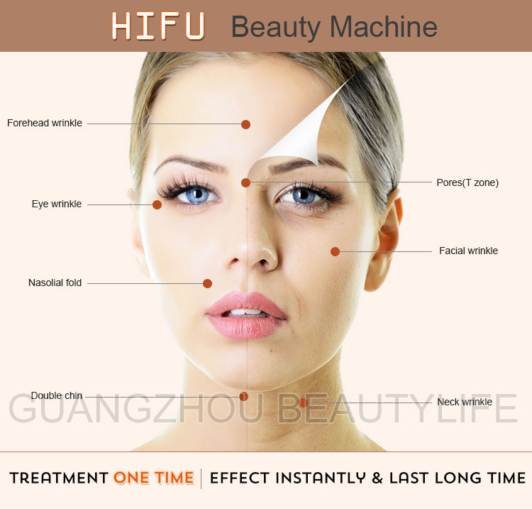 hifu ultherapy