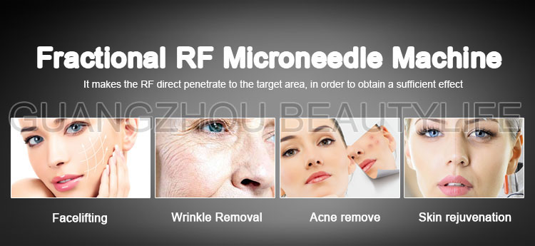 fractional rf treatment