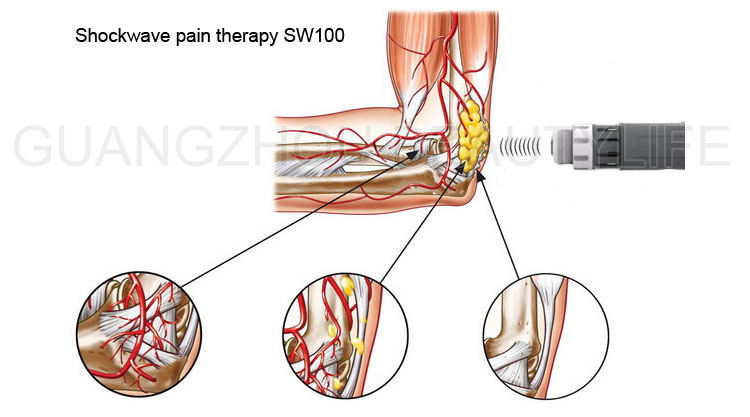 shockwave pain therapy