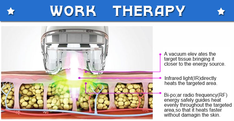 velashape work therapy