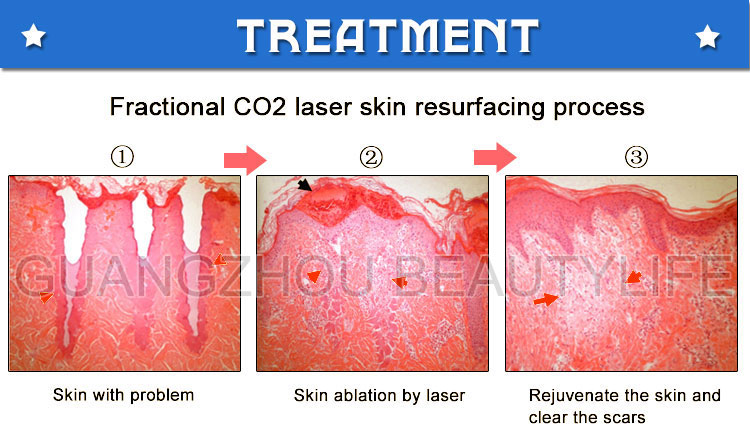 fractional co2 laser treatment