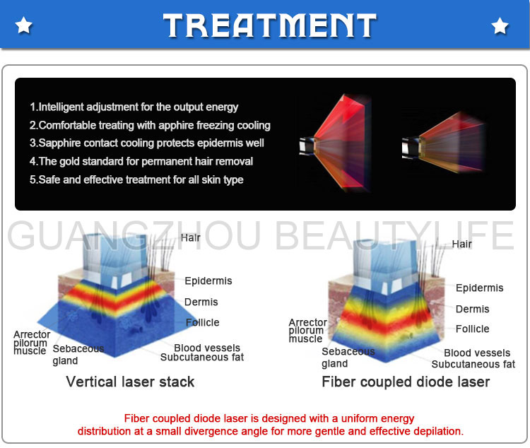 diode laser hair removal