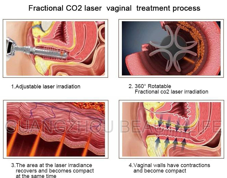 rf tube fractional co2 laser