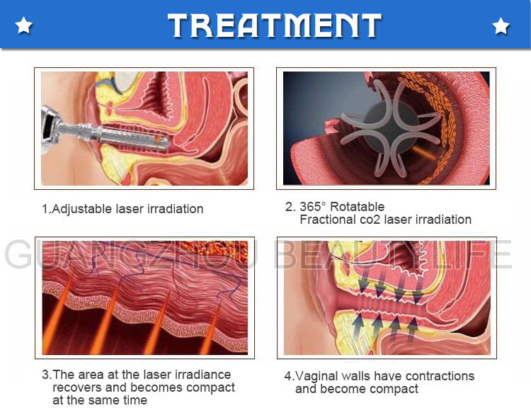 portable fractional co2 laser
