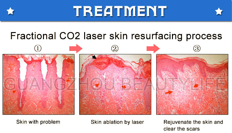 fractional co2 laser treatment