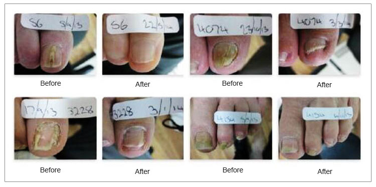 what is the most effective treatment for toenail fungus what is the most effective treatment for toenail fungus