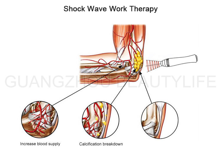 shockwave therapy machine