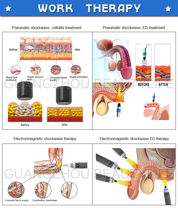 shockwave physiotherapy