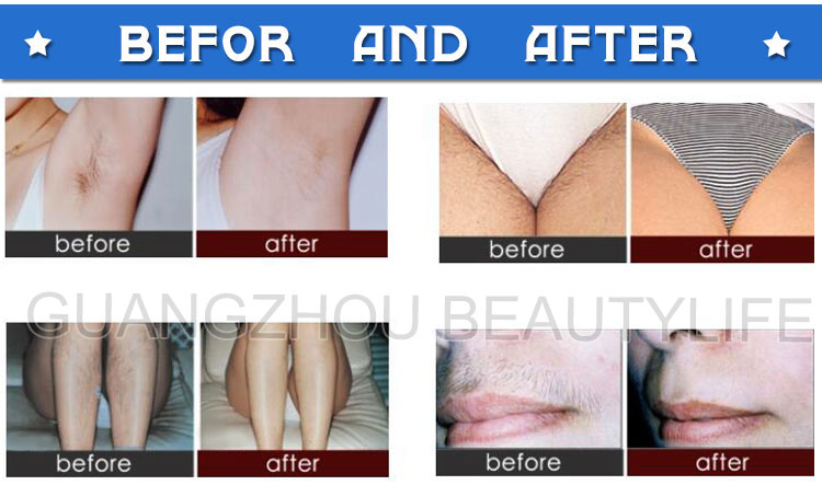 hair removal before and after